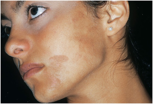 Get rid of skin pigmentation naturally